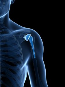 Center for spinal disorders- shoulder replacement