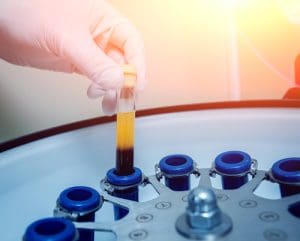 Platelet-Rich Plasma May be the Answer for Treating Injuries