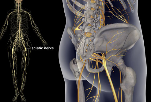 Top 4 Causes of Sciatica 1