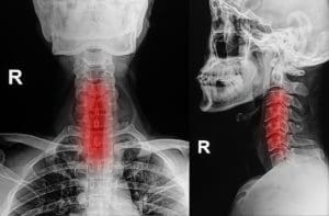 Spinal Stenosis Explanation